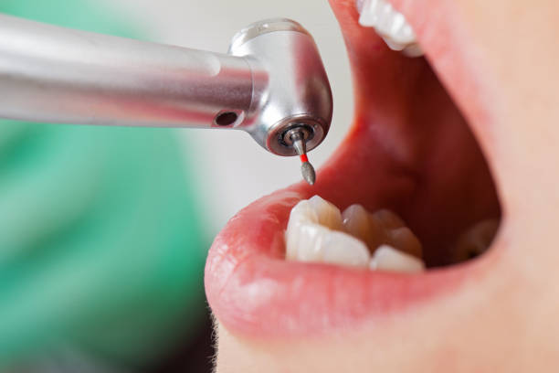 Best Emergency Root Canal Treatment in Guin, AL